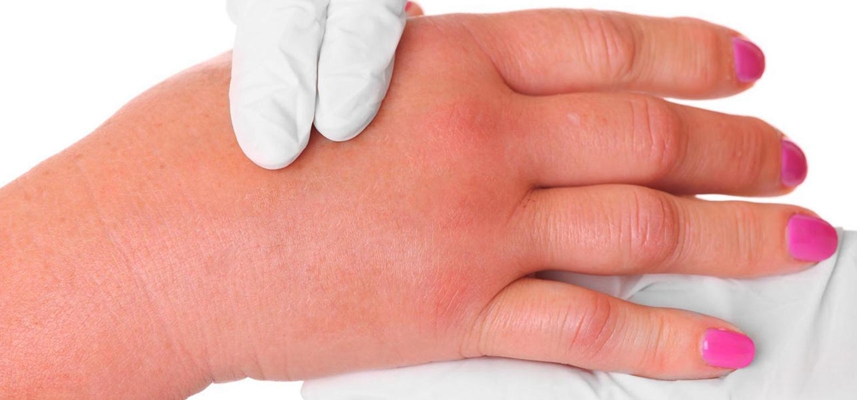 肢端肥大症  (4) 