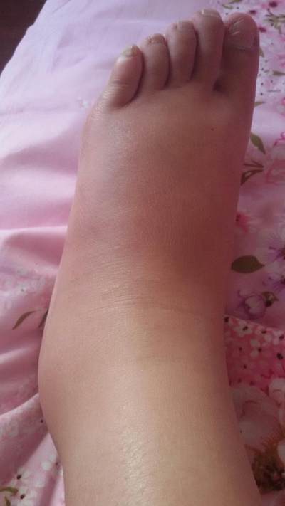 肢端肥大症  (32) 