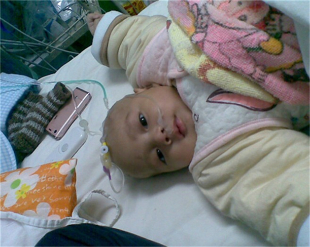 先天性喉喘鳴治療