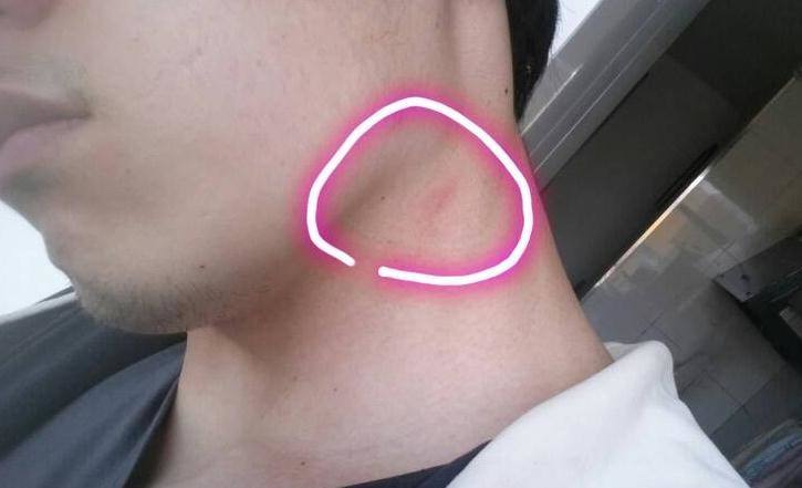 慢性淋巴結炎 (38) 