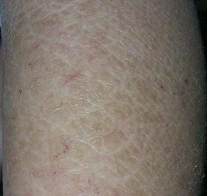 小腿皮膚像魚鱗 (5) 