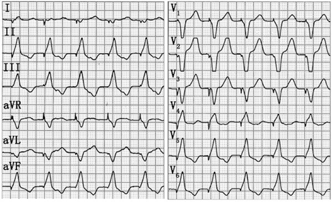 房顫心電圖特點 (60) 