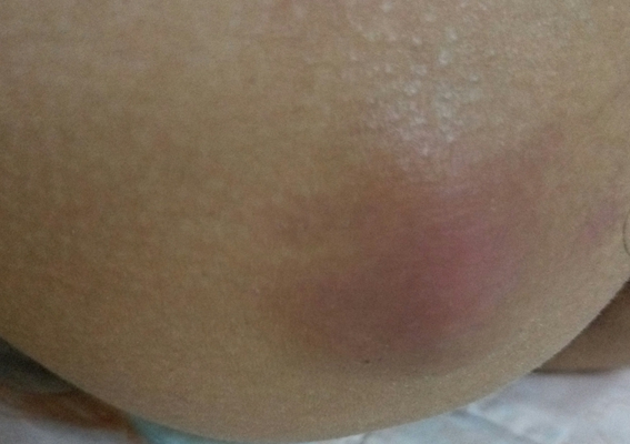 臀部癤子的症狀