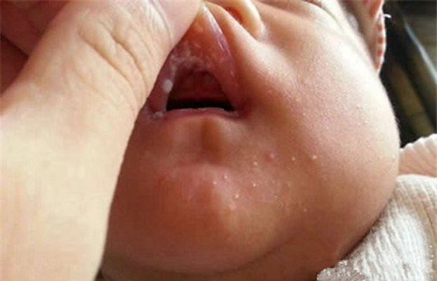 寶寶鵝口瘡 (7) 