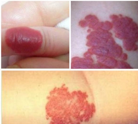 紅斑結節圖 (56) 