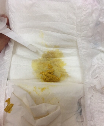 新生兒消化不良大便圖 (54) 