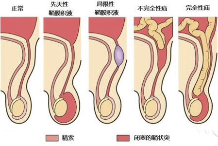 小兒鞘膜積液 (5) 