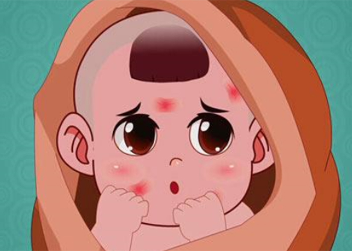 兒童鮮紅斑痣有多常見 