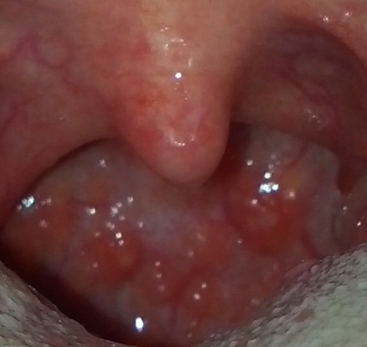 扁桃體癌圖  (9) 