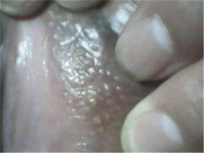 絨毛假性溼疣女性