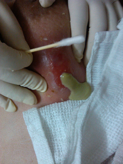 治療乳腺炎化膿