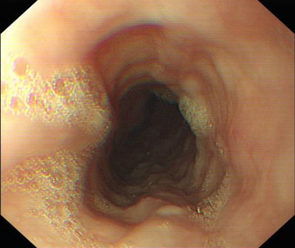 急性胃炎的陽性的表現的