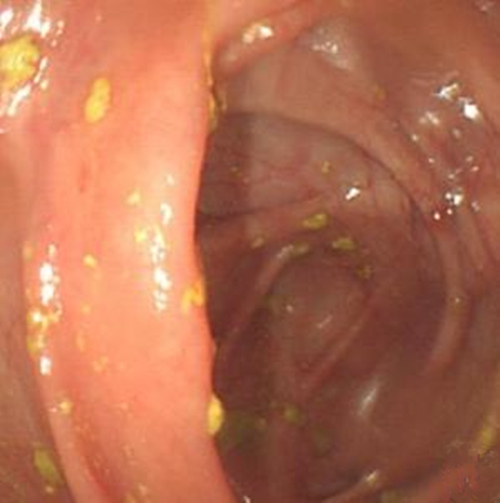 中期慢性結腸炎患者的