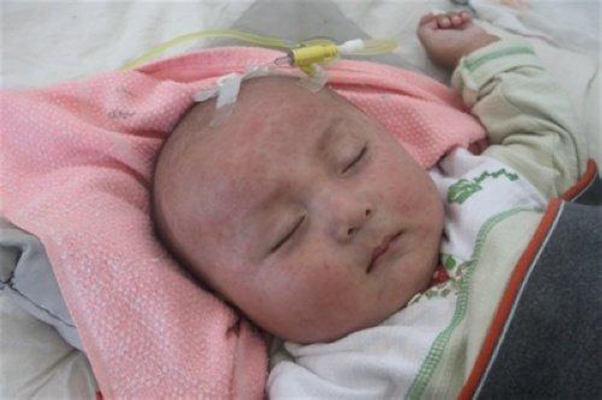 小兒猩紅熱症狀