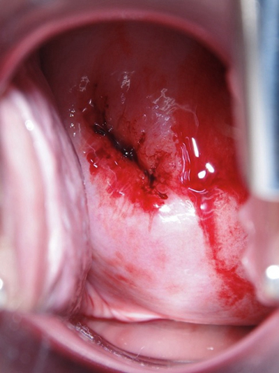 宮頸糜爛 (6) 