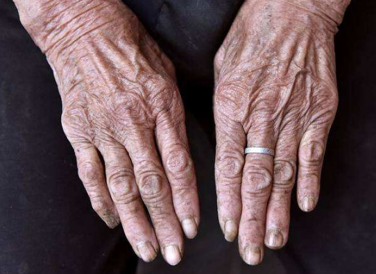 特發性震顫 (62) 