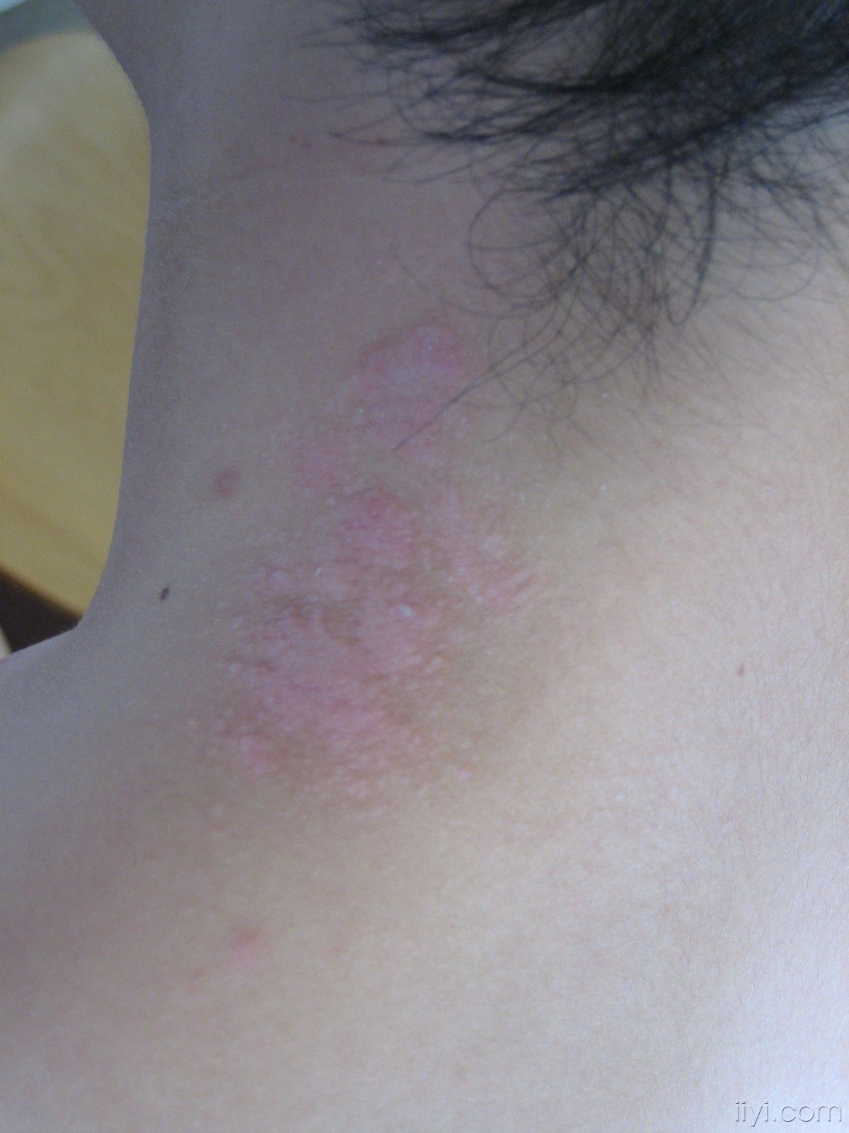 脖子日光性皮炎