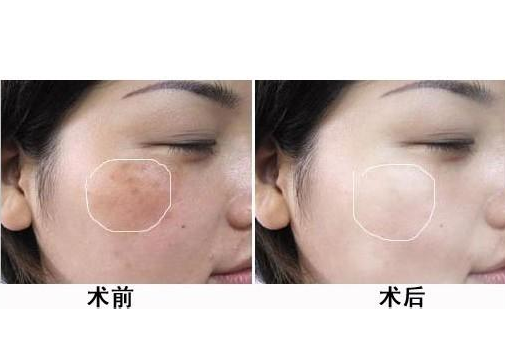 磨皮手術效果圖 (8) 