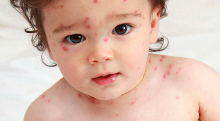 嬰兒風疹