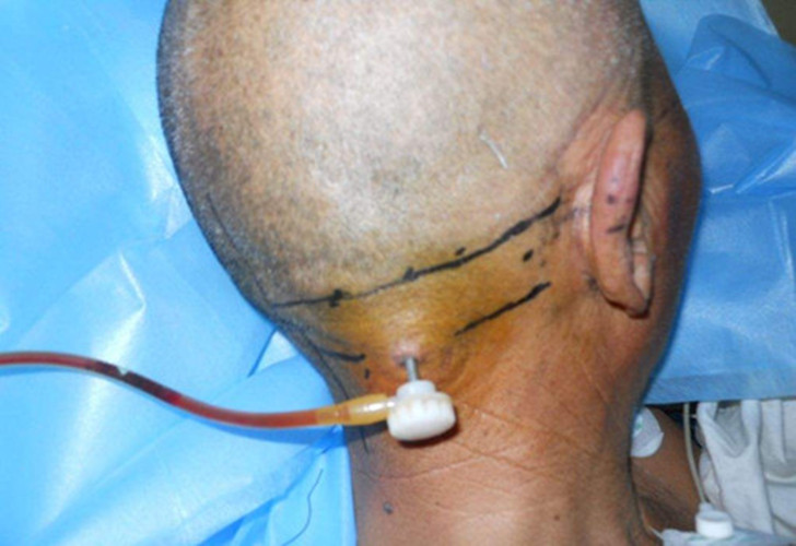 小腦出血50毫升手術