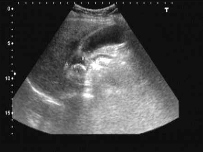 膽結石疼痛部位圖 (9) 