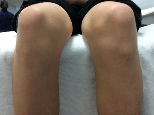 脛骨結節骨骺炎 (46) 