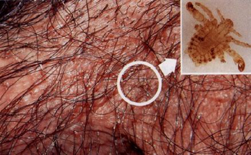 陰蝨潛伏期具體症狀的