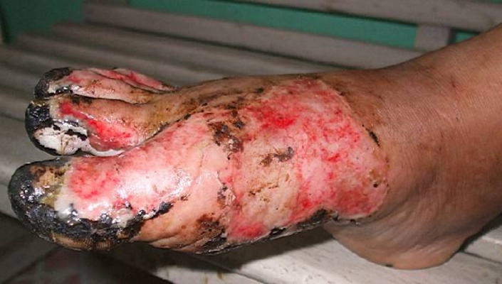 深二度燒傷 (47) 