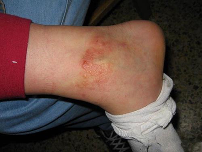 腳腕接觸性皮炎