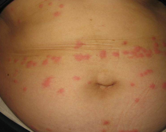 玫瑰糠疹母斑