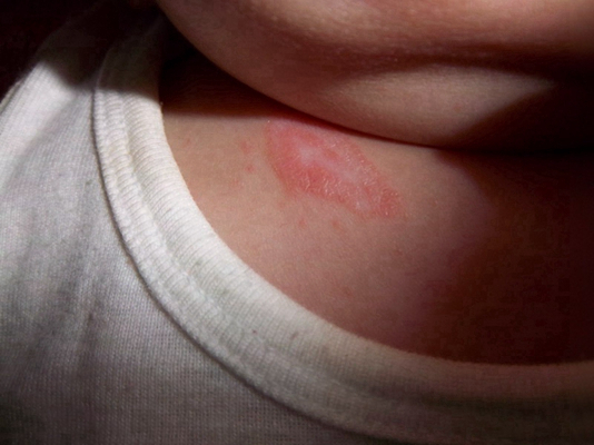 新生兒胎毒的症狀