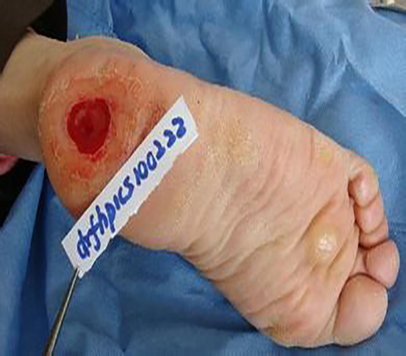 左足底滑膜肉瘤