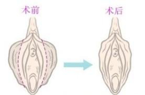 陰唇肥大凸出來