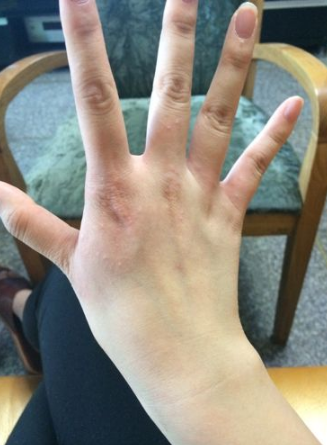 孕婦膽汁淤積症狀