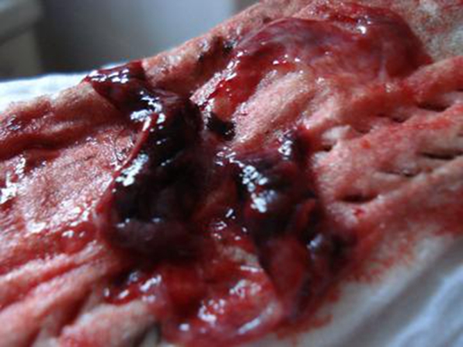 早孕藥流出來的孕囊