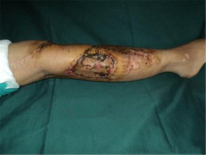 如何治療骨髓炎