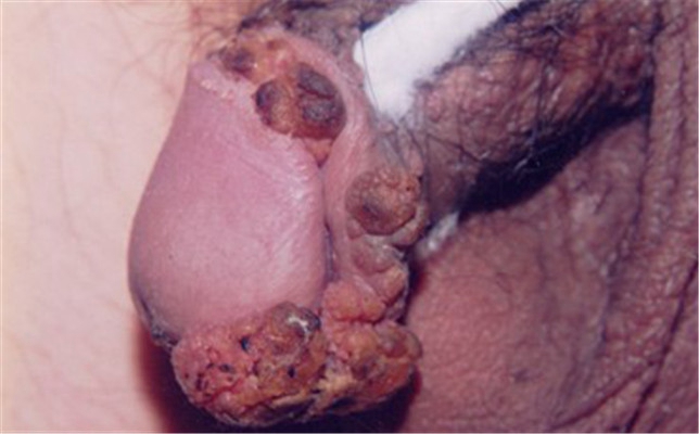 性病性淋巴肉芽腫套圖 (7) 