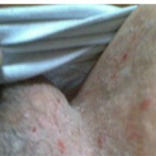 嚴重外陰溼疹表現