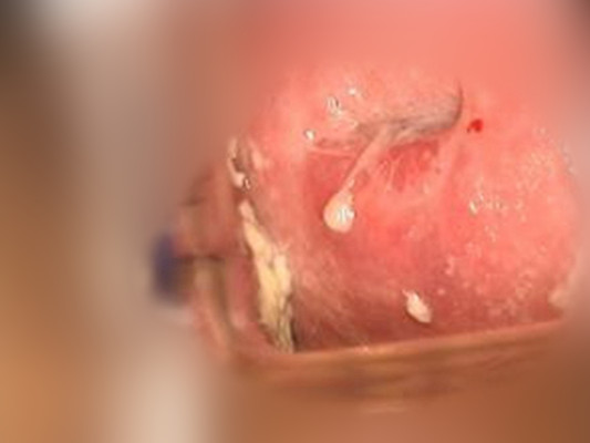 黴菌陰炎症狀 (46) 