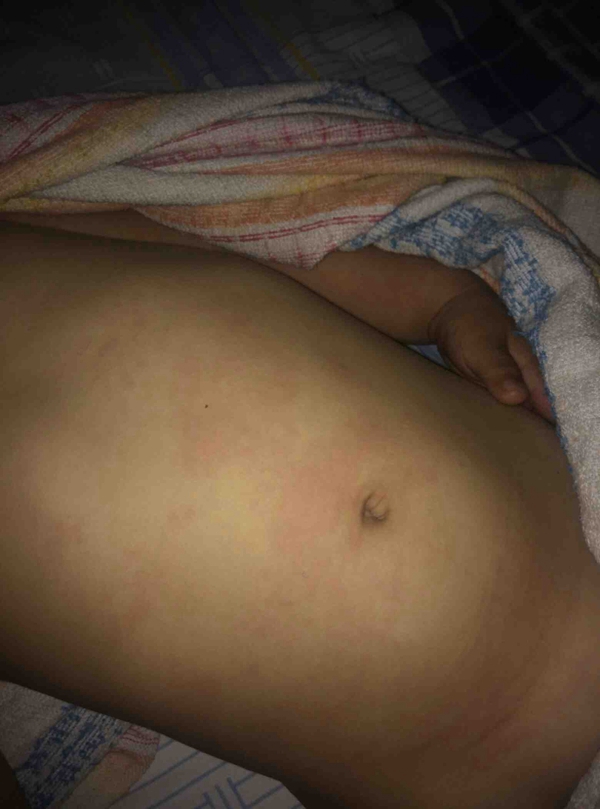 小兒輕度流感症狀