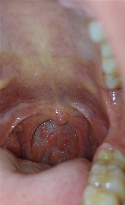 喉部淋巴濾泡增生 (49) 