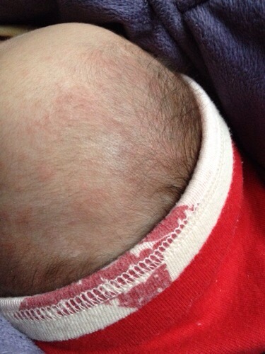 小兒急疹的症狀 (50) 