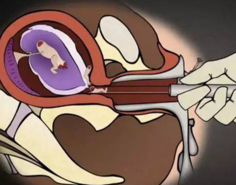 治療中人工陰道
