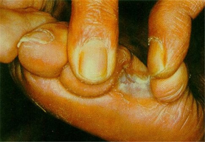 已感染的糖尿病足