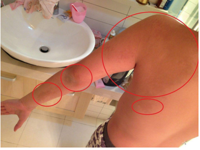 牛奶咖啡斑 (50) 