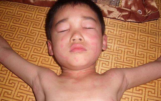 身體蟎蟲過敏症狀