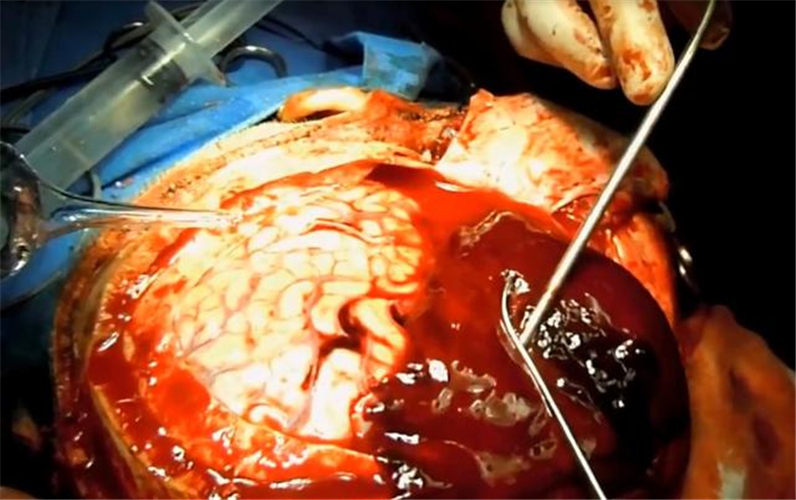 手術治療腦疝過程