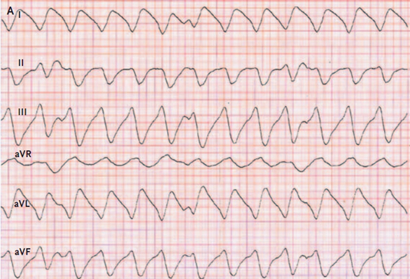 房顫心電圖特點 (67) 