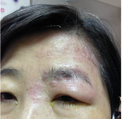 帶狀皰疹樣外觀