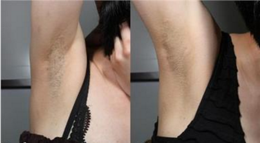 腋部腹部皮膚黑變病